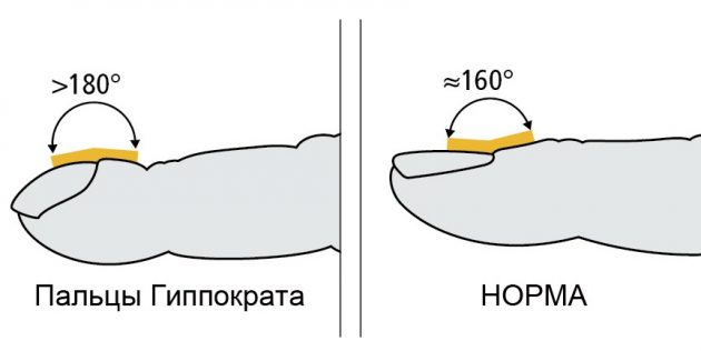 Пальцы Гиппократа Пальцы Гиппократа