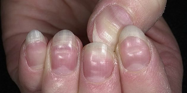 Поперечные бороздки Поперечные бороздки