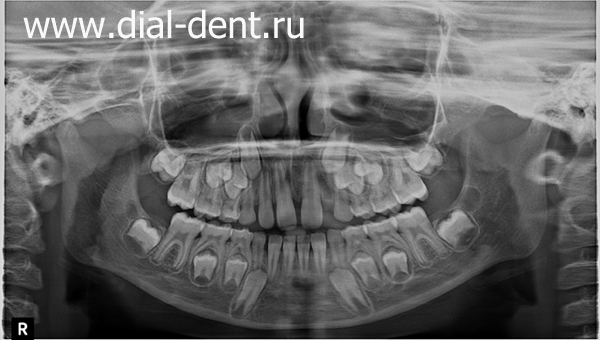 панорамный снимок зубов в сменном прикусе
