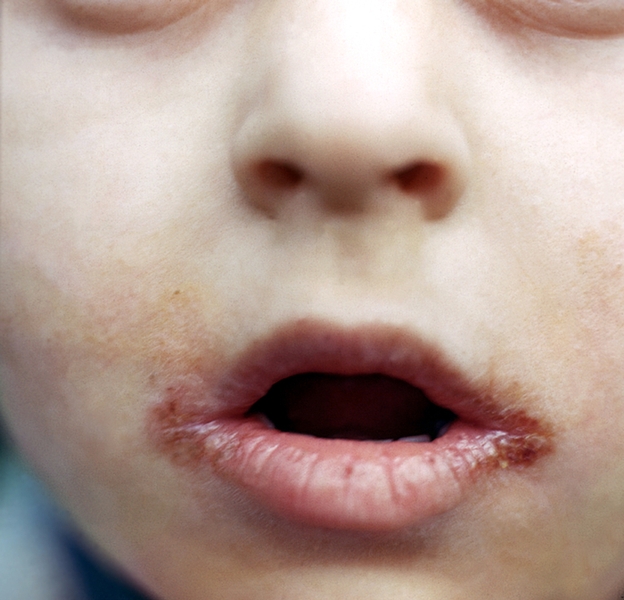 Ребенок со стрептококковой заедой: трещины в углах рта, покрывающиеся корками