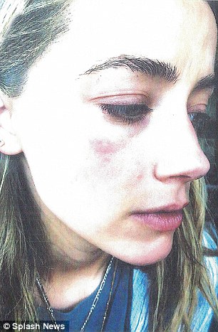 Photographs of the bruising on Amber Heard