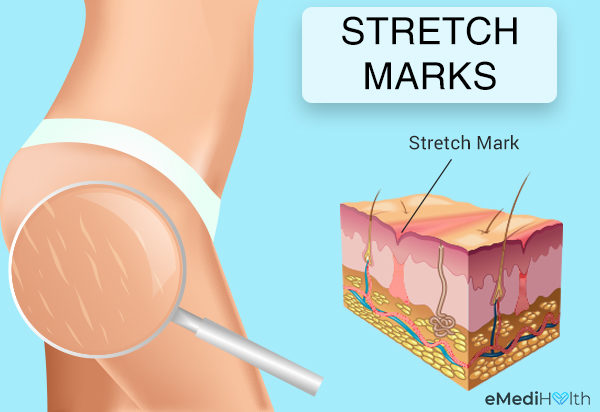 Stretch marks diagrammatic representation