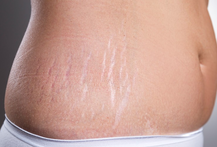 Reducing stretch marks