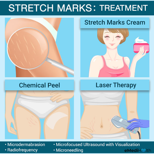 Medical treatment for stretch marks