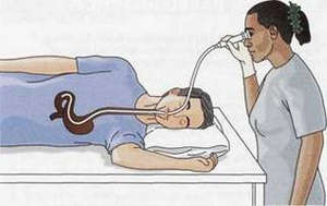 Процедура гастроскопия