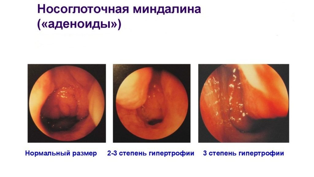 Формы и стадии аденоидита Формы и стадии аденоидита