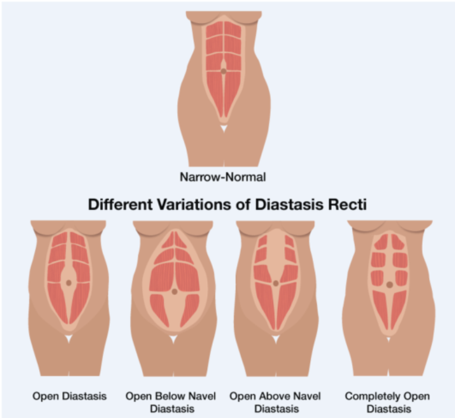 diastasis stages