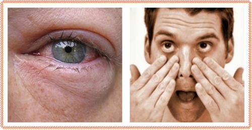 Синяки под глазами у мужчин: причины, лечение, поводы для беспокойства