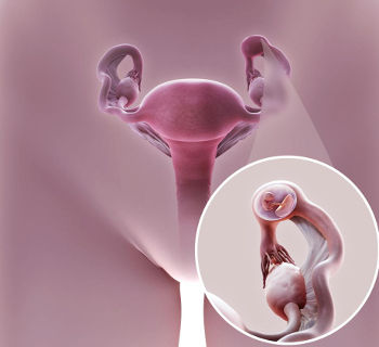 Почему бывает внематочная беременность